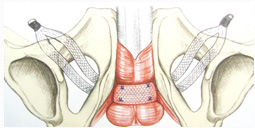 Chirurgie : les bandelettes urétrales
